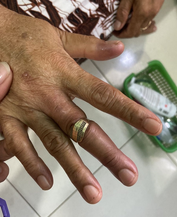 Damkar Sidoarjo Bantu Lepaskan Cincin Nenek 64 Tahun di Pilang Wonoayu
