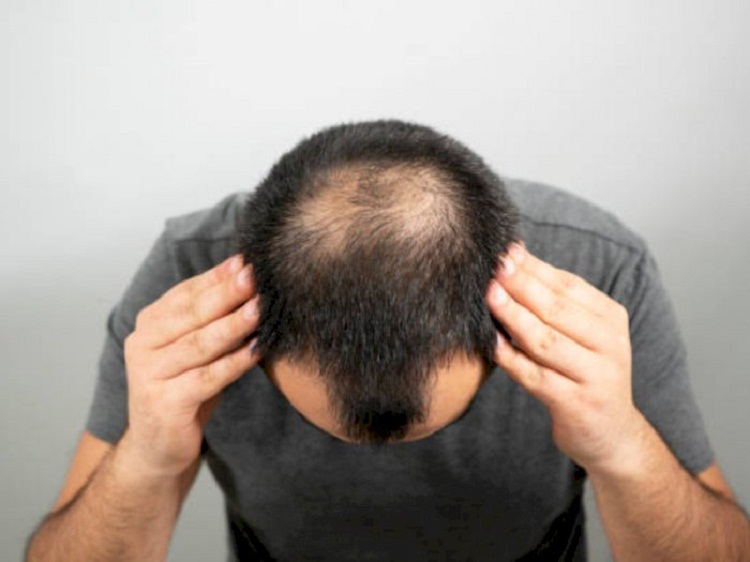 Pria Botak Berisiko Tinggi Terinfeksi Covid-19 Parah